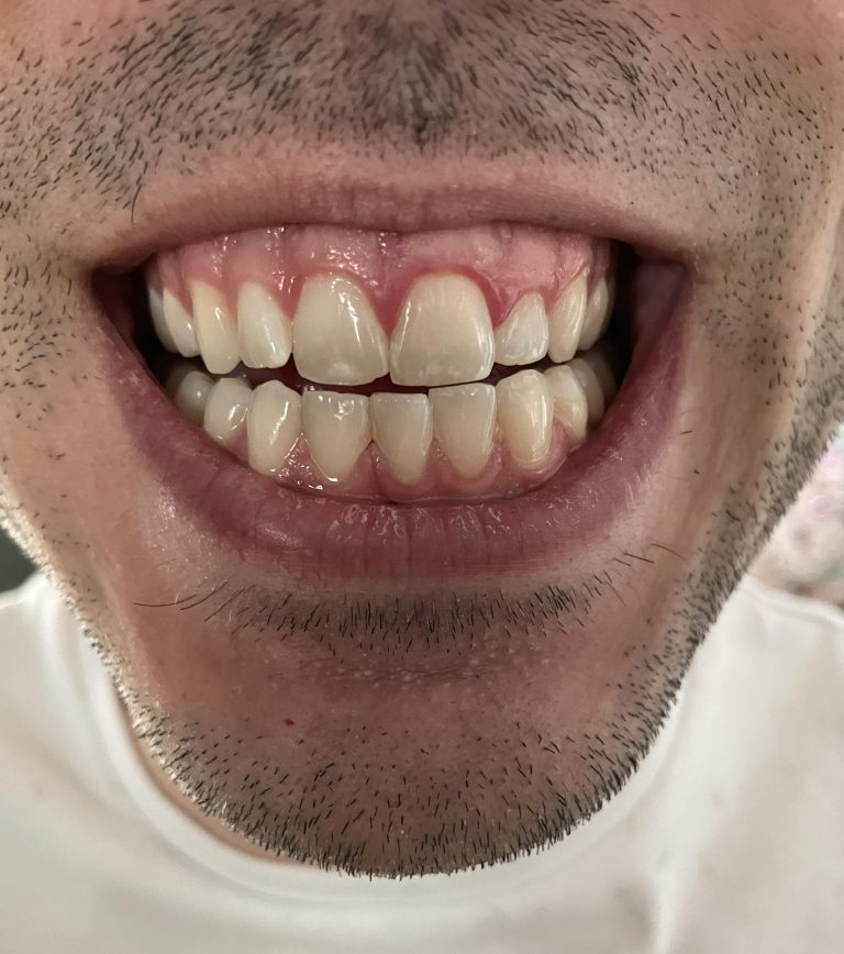 التهاب مزمن لثه