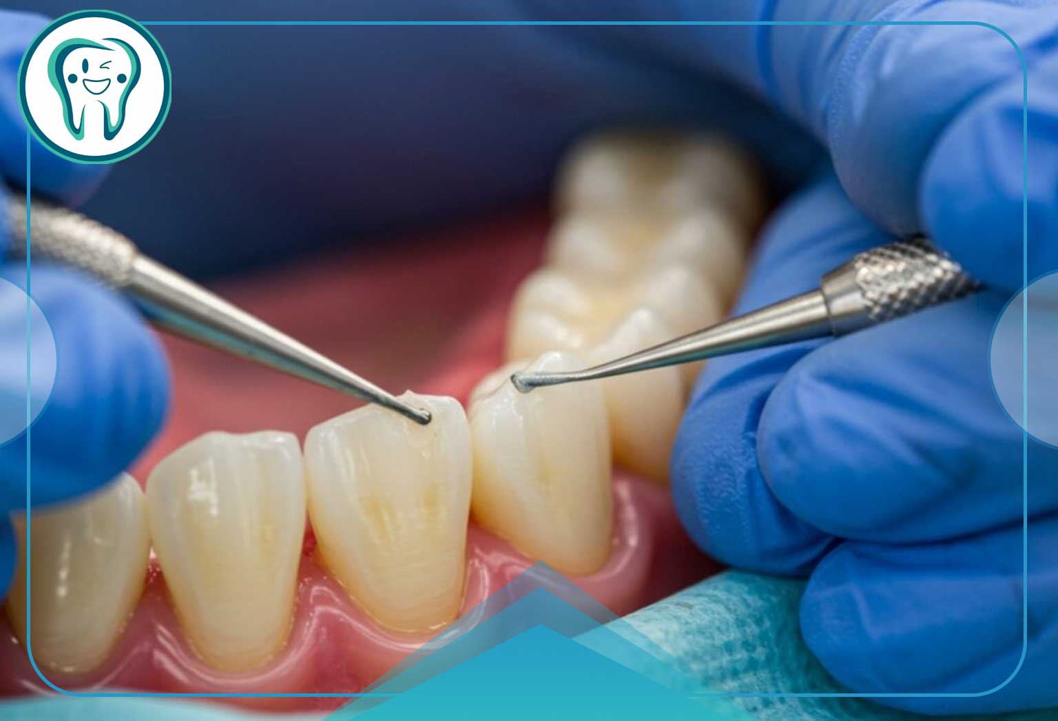 کاربردهای کامپوزیت IPS در دندانپزشکی