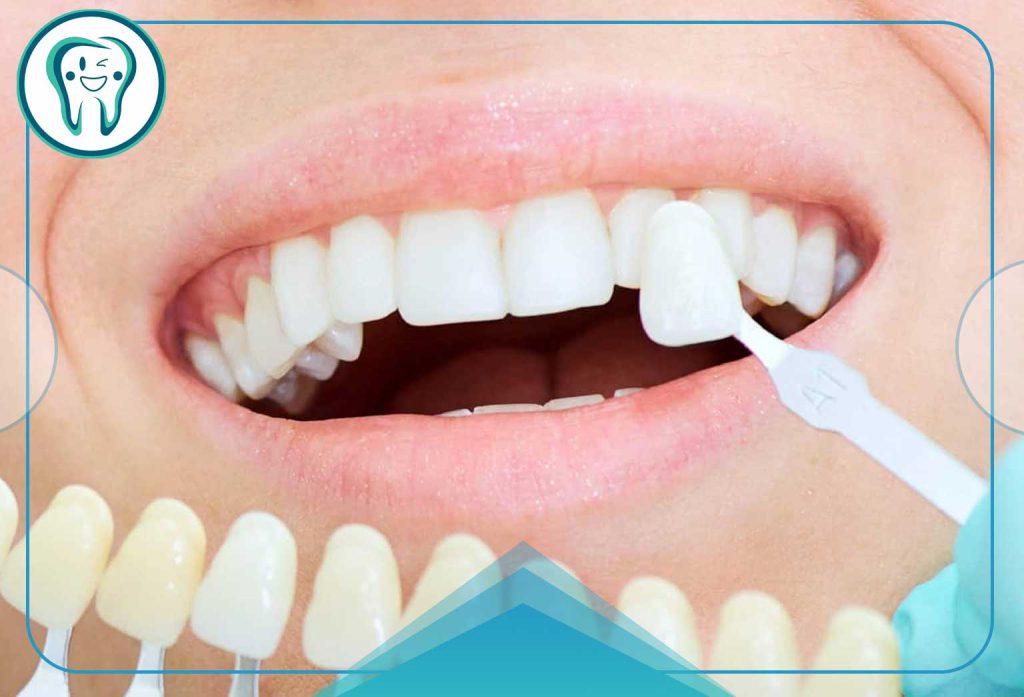 کامپوزیت IPS