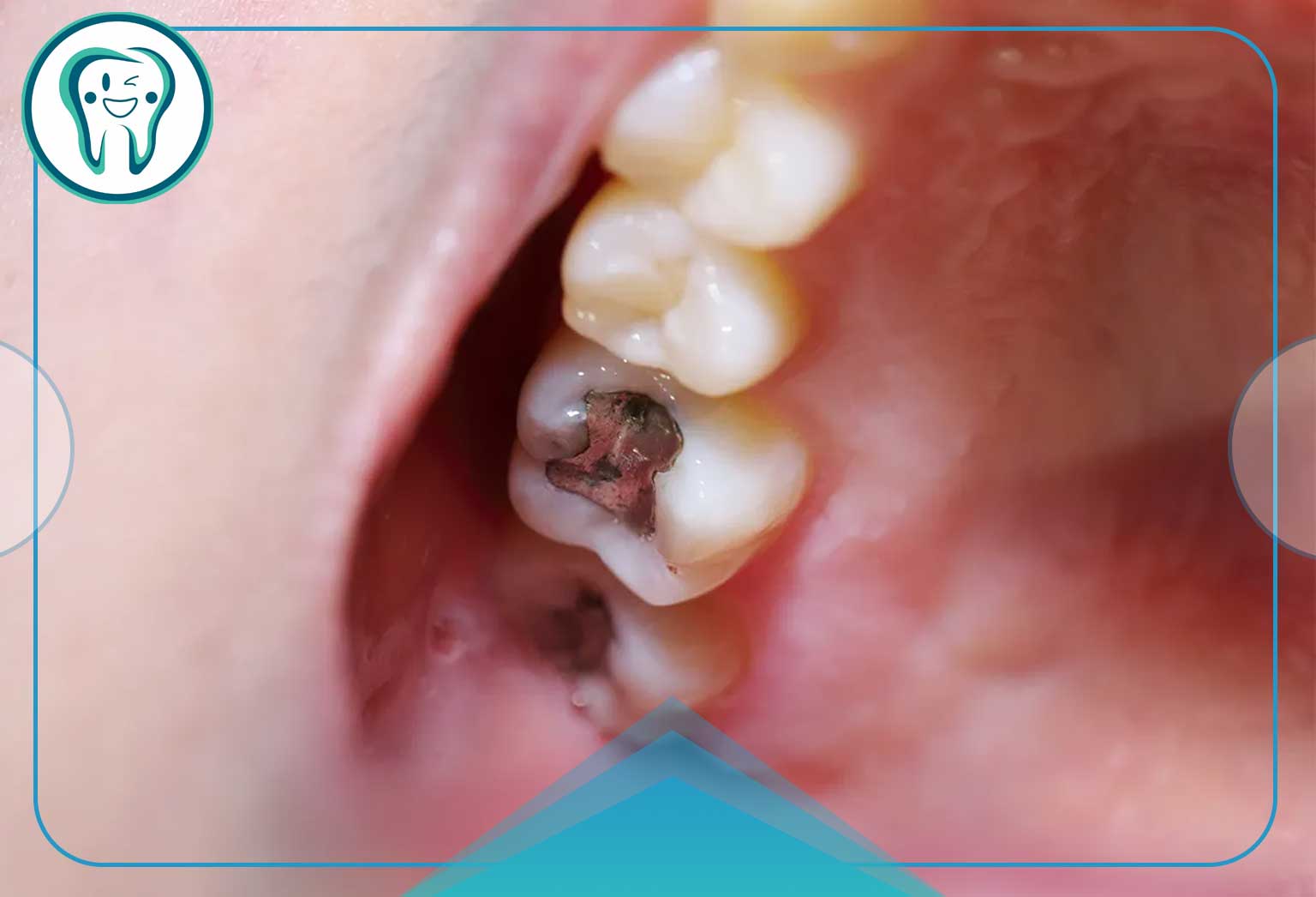 افزایش طول عمر دندان ترمیم‌شده