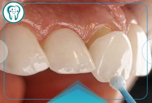 روکش دندان عصب کشی شده