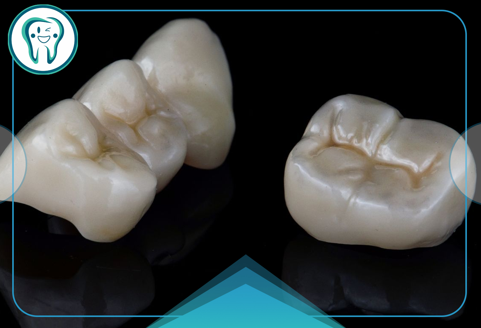 مشکلات بریج دندان | دلایل، عوارض و روشهای پیشگیری 5 دلایل بروز مشکلات در بریج دندان