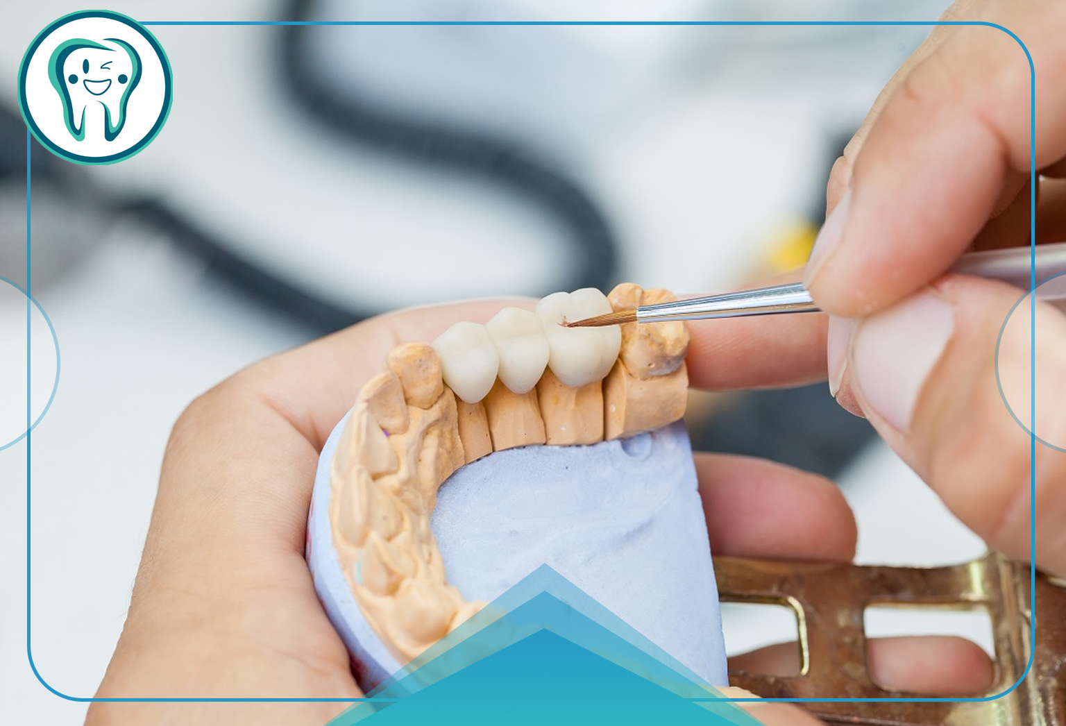 مشکلات بریج دندان | دلایل، عوارض و روشهای پیشگیری 4 دلایل بروز مشکلات در بریج دندان