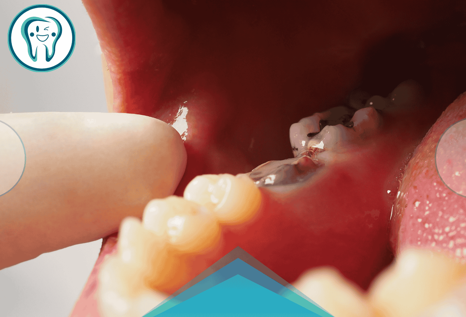 عصب‌کشی و پر کردن دندان