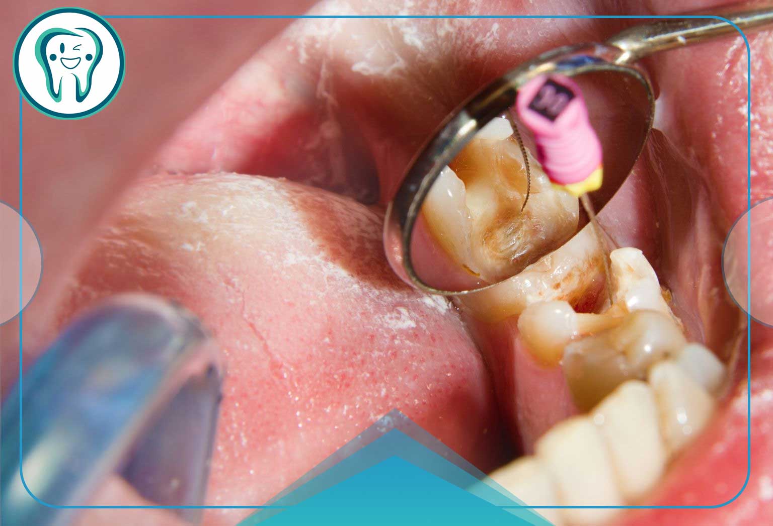 دندان عصب‌کشی شده 