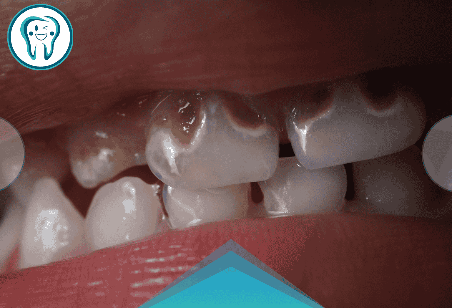 شکل‌دهی و آماده‌سازی کانال‌ها: