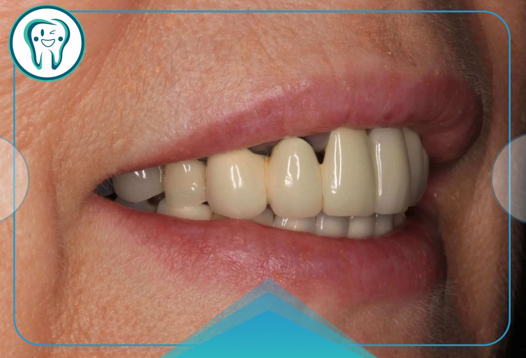 مشکلات بریچ دندان