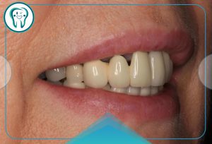 مشکلات بریچ دندان