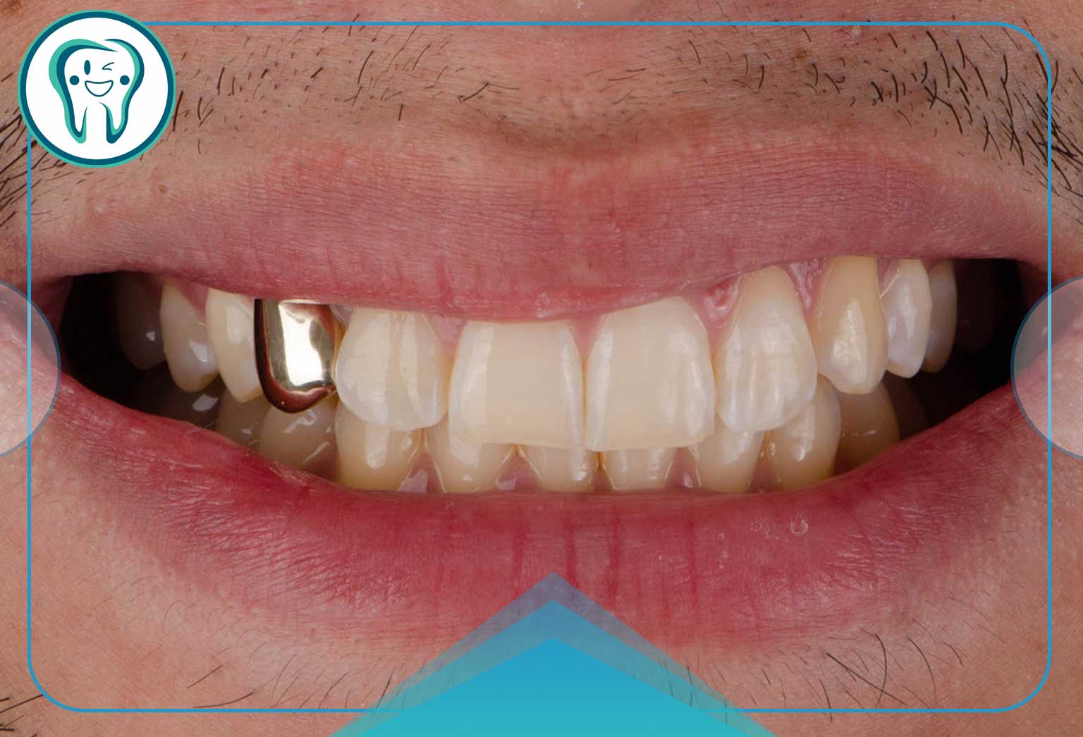 بهترین نوع روکش برای دندان عصب‌کشی‌شده