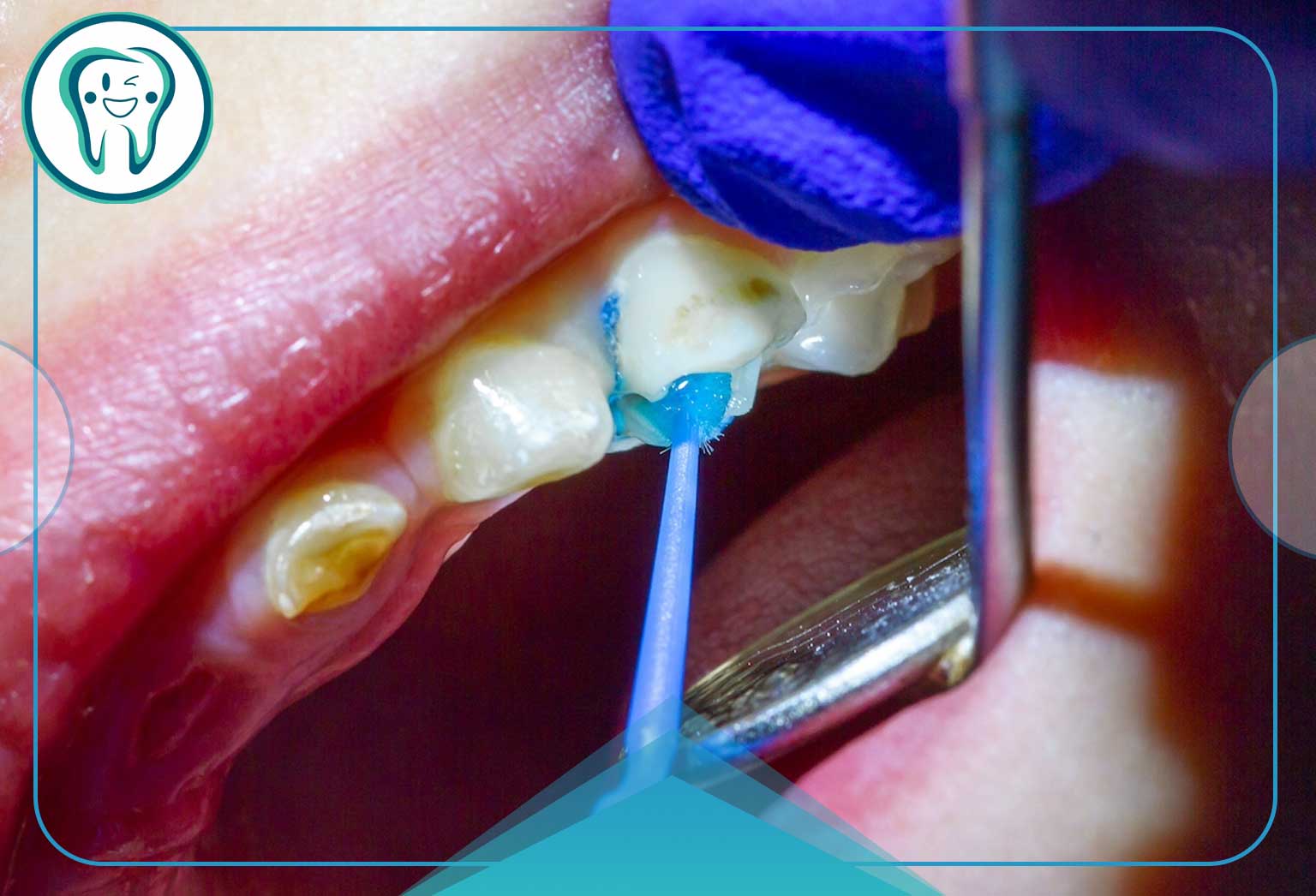 تفاوت پرکردگی دندان عصب‌کشی‌شده