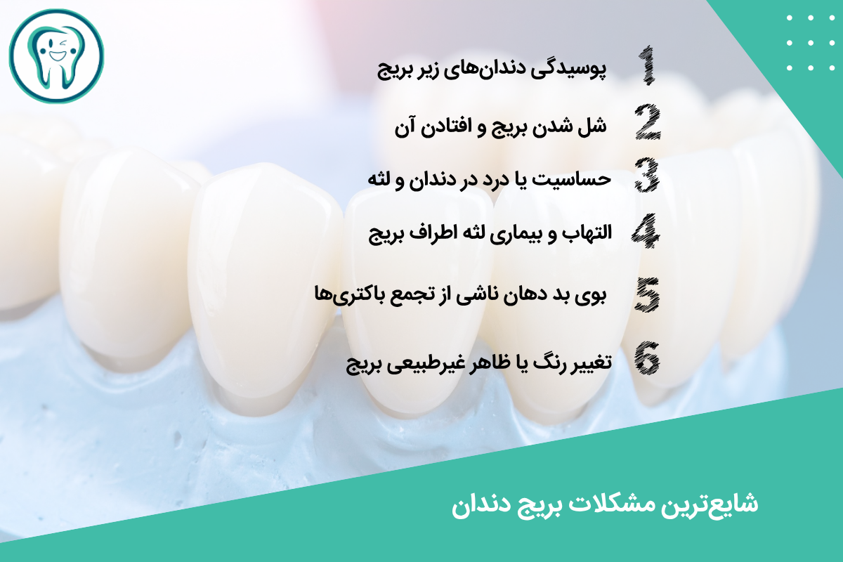 مشکلات بریج دندان | دلایل، عوارض و روشهای پیشگیری 2 شایعترین مشکلات بریج دندان