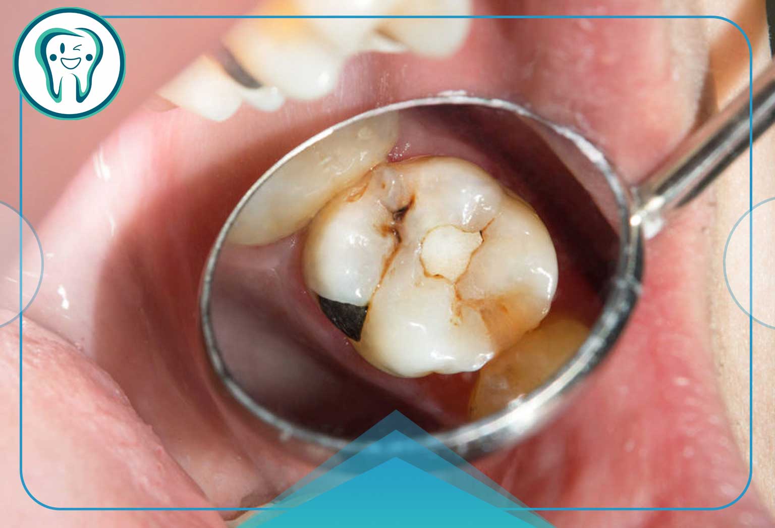 ترمیم مجدد دندان