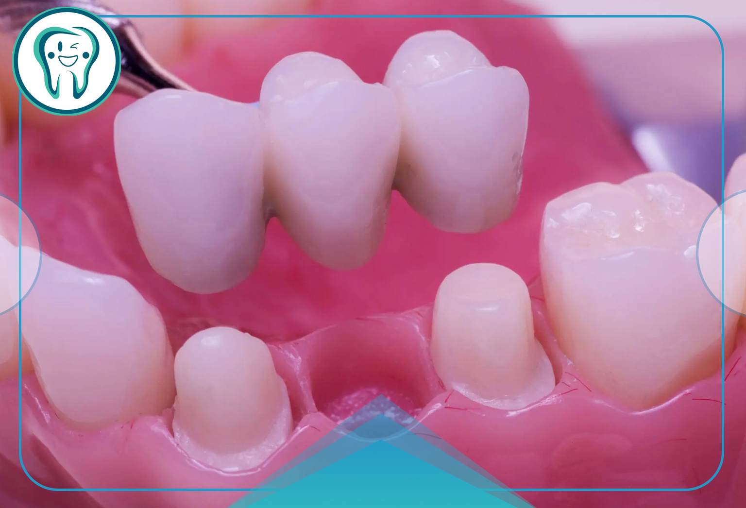 مشکلات بریج دندان | دلایل، عوارض و روشهای پیشگیری 1 انواع بریج دندان