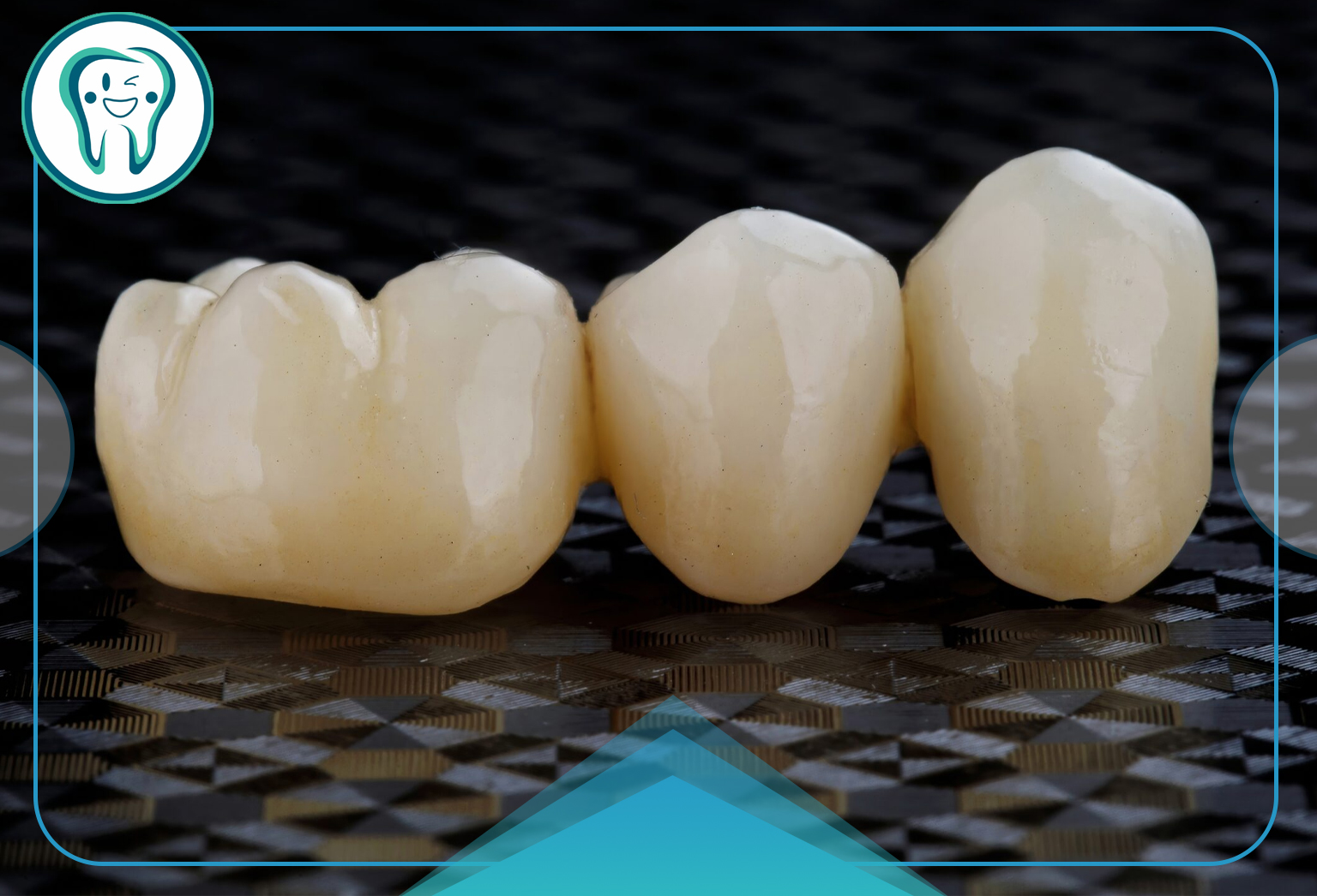 مشکلات بریج دندان | دلایل، عوارض و روشهای پیشگیری 3 علائم هشداردهنده در بریجهای معیوب