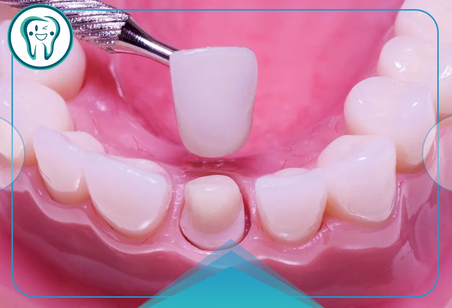 مراحل نصب روکش دندان  عصب کشی شده