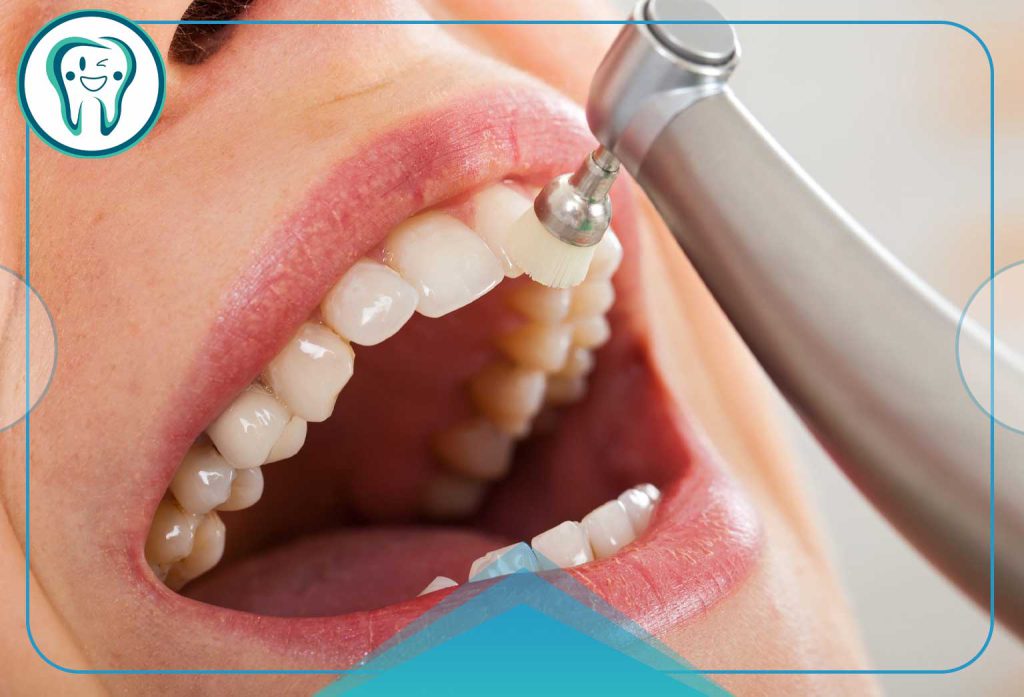 جرمگیری دندان