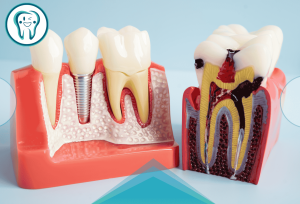 بعد از عصب‌کشی دندان