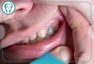 سیاه شدن دندان زیر روکش