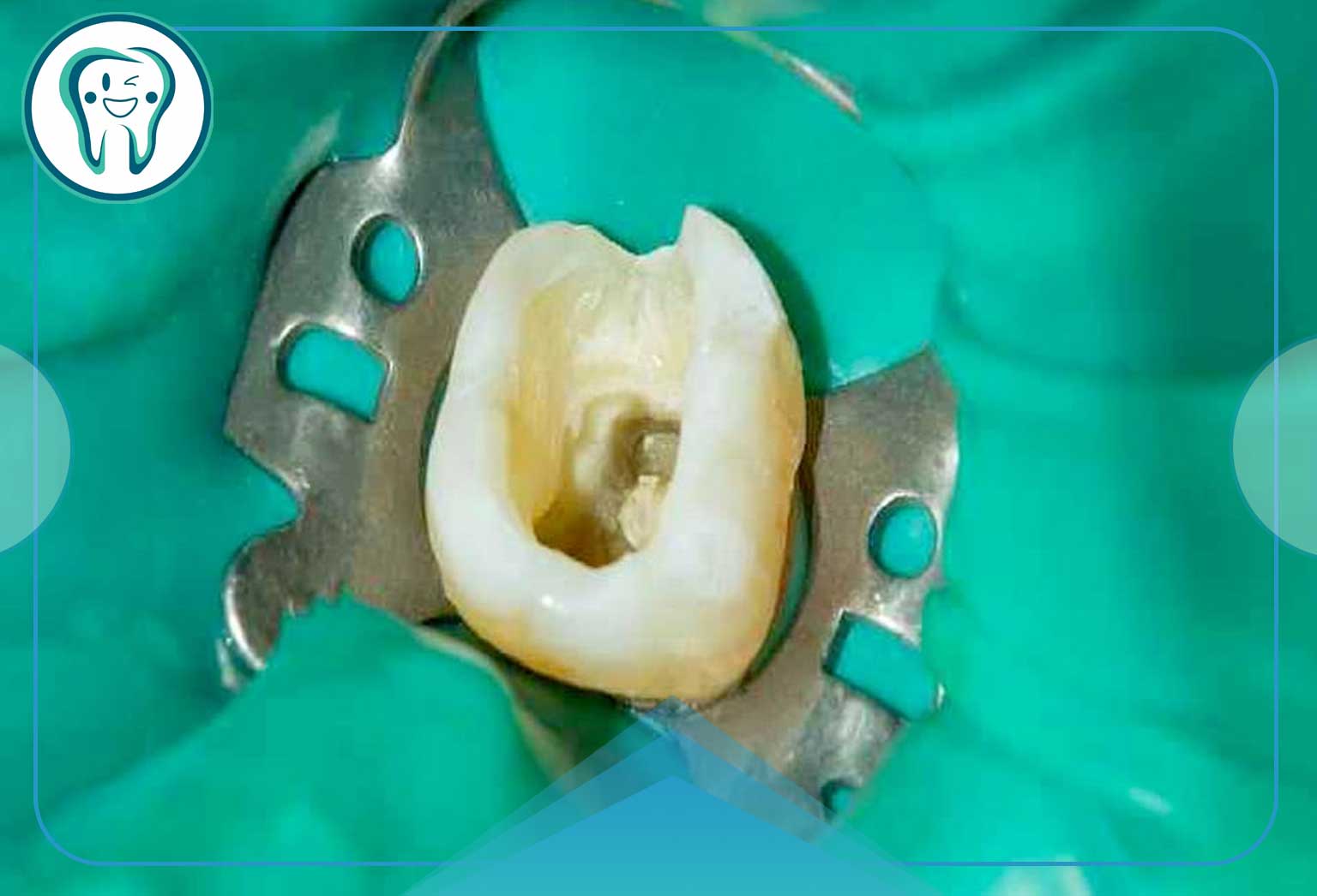 راهنمای کامل عصب کشی مجدد دندان؛ مراحل، دلایل، هزینه و مراقبتها 4 چالشهای عصبکشی مجدد دندان