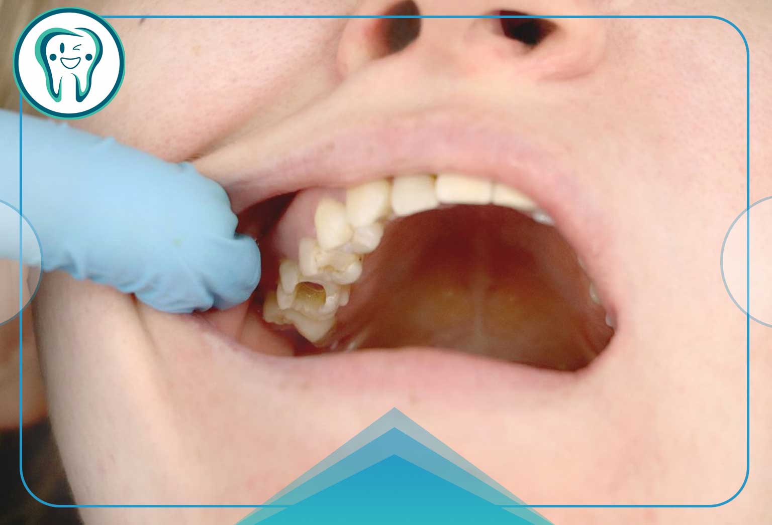 عوارض عصب کشی نادرست دندان