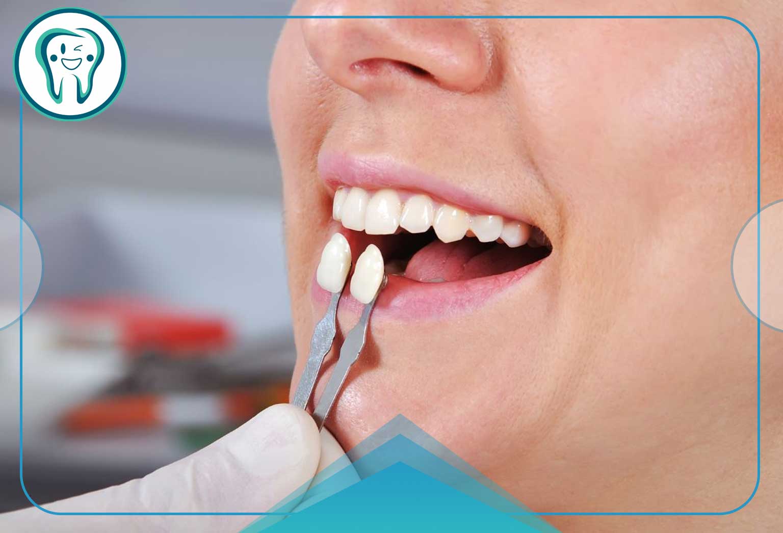 روش‌های مختلف ترمیم دندان جلو