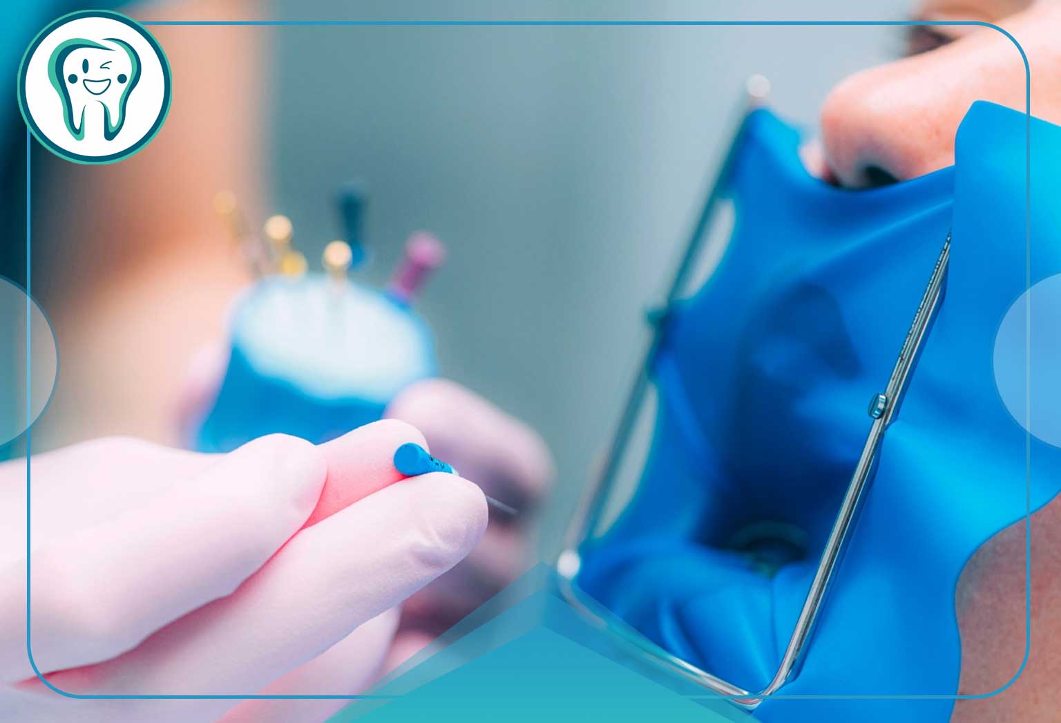 راهنمای کامل عصب کشی مجدد دندان؛ مراحل، دلایل، هزینه و مراقبتها 5 جراحی انتهای ریشه دندان