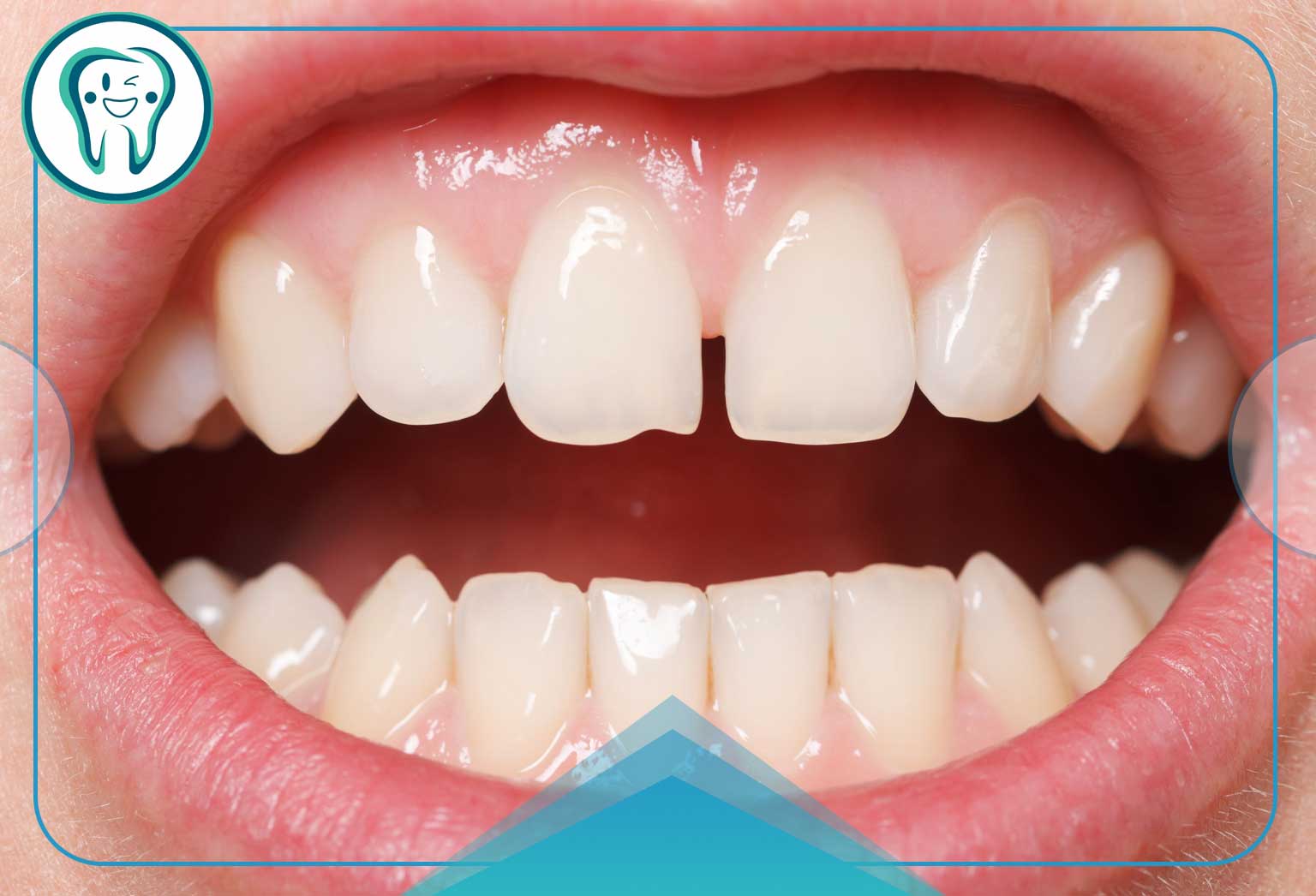 مشکلات دندان جلو