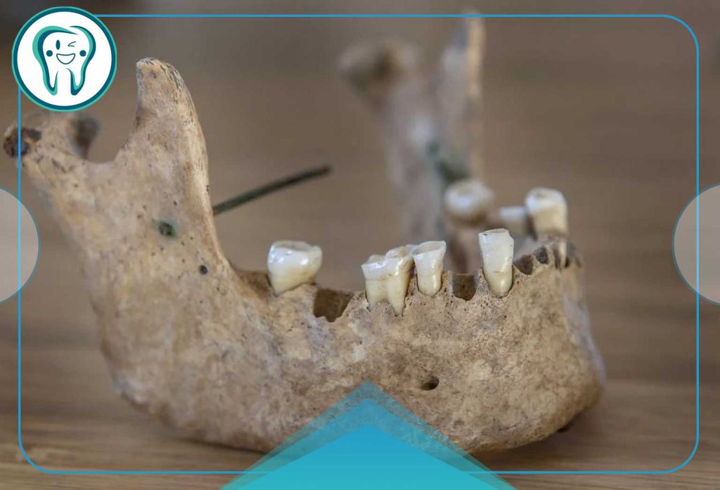 Osteolysis of the jaw