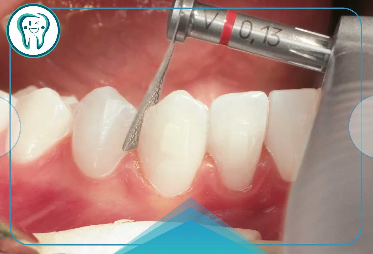 استریپ دندان؛ تجربهای سریع و بدون درد برای سفیدی دندان 5 مراقبتهای بعد از استریپینگ دندان