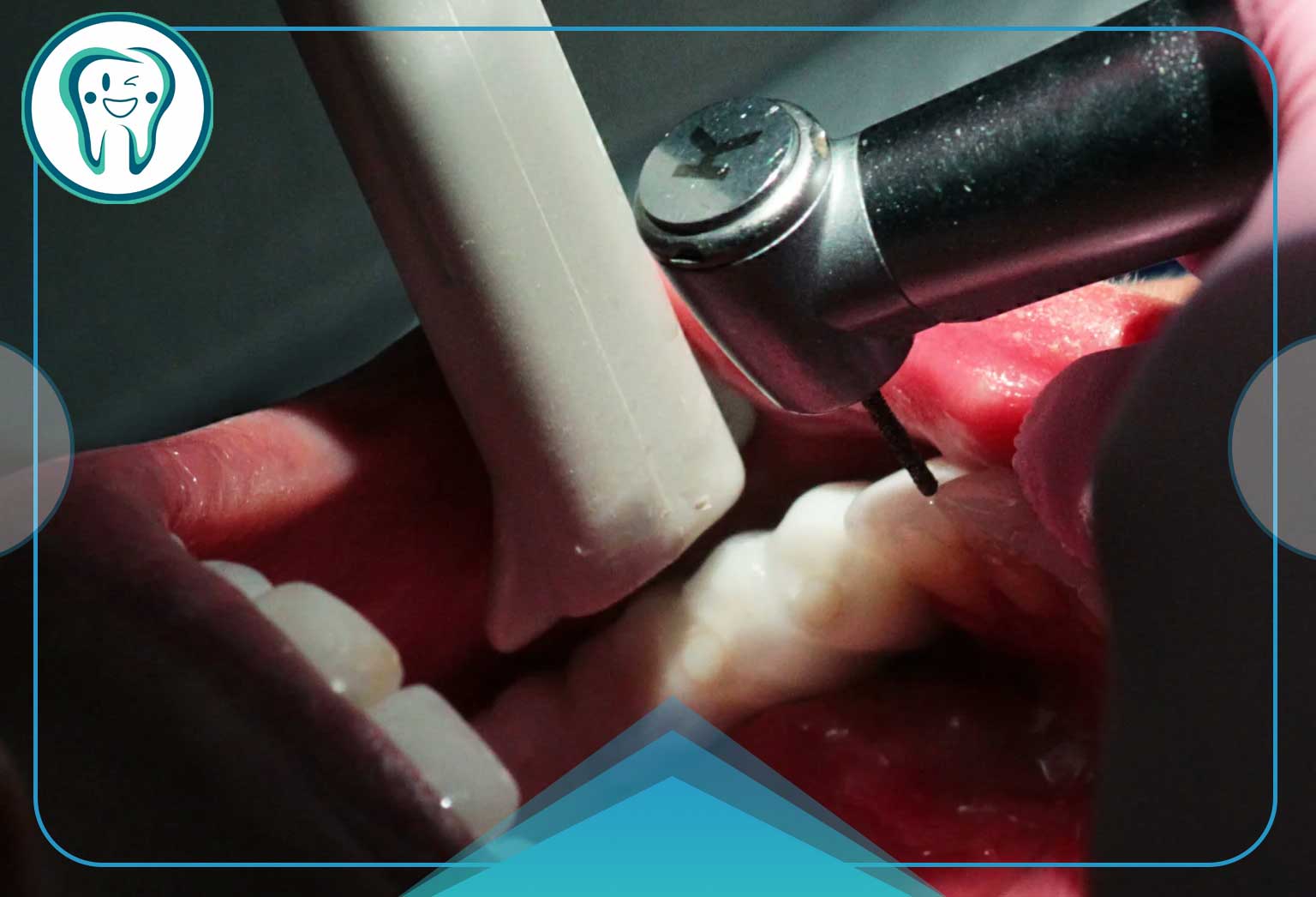 راهنمای کامل عصب کشی مجدد دندان؛ مراحل، دلایل، هزینه و مراقبتها 1 عصب کشی مجدد دندان