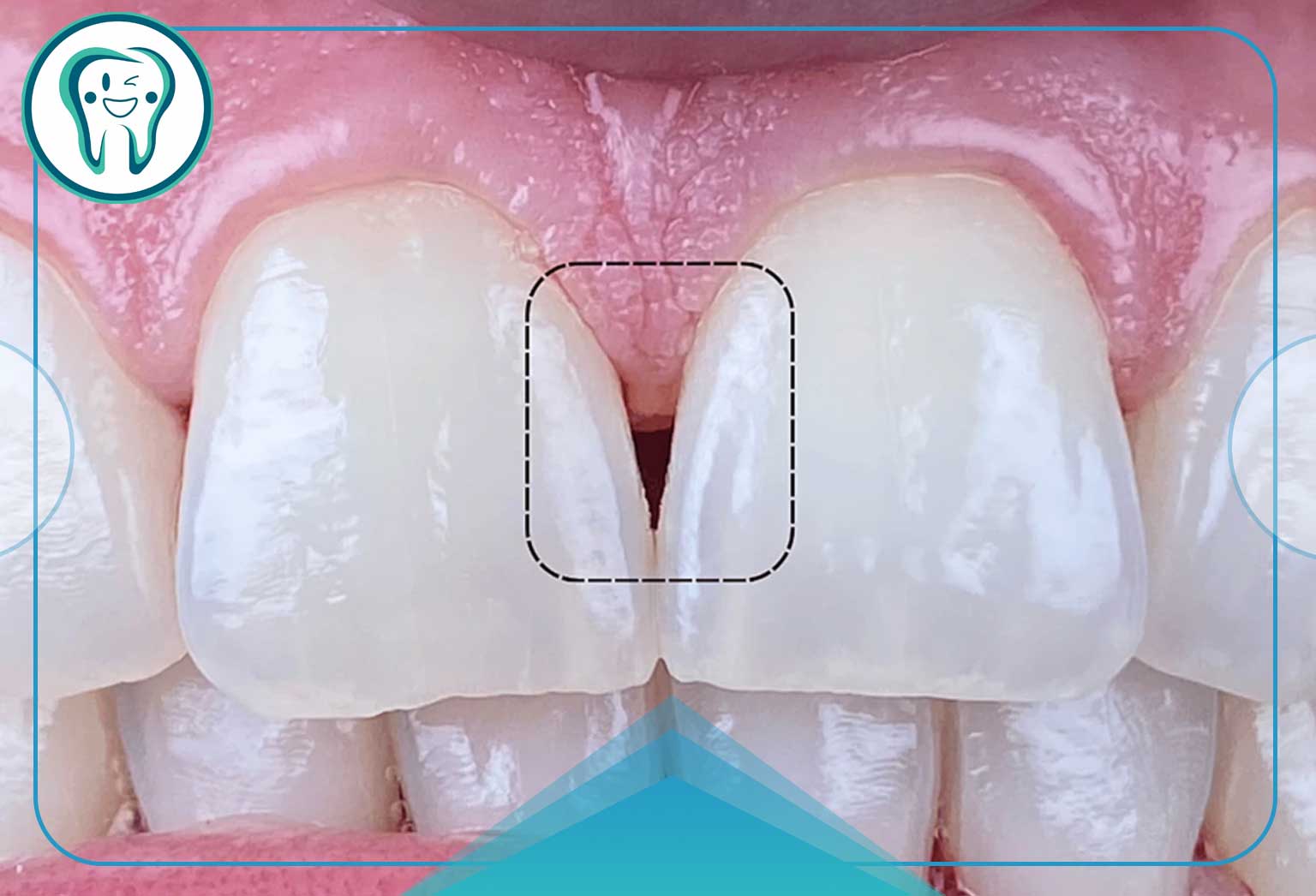 استریپ دندان؛ تجربهای سریع و بدون درد برای سفیدی دندان 1 دلیل استریپ کردن دندان
