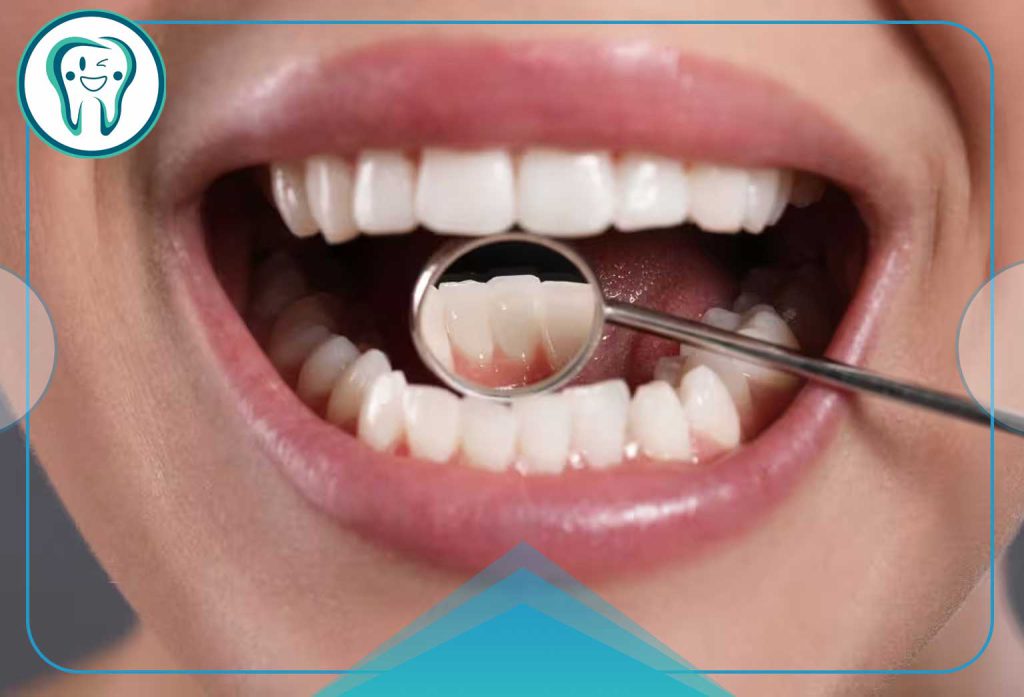 ترمیم دندان جلو