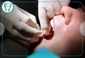 استریپ دندان