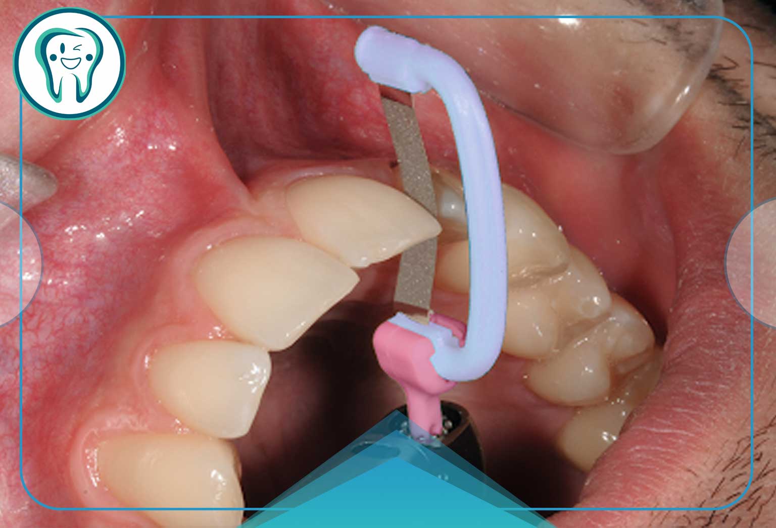 استریپ دندان؛ تجربهای سریع و بدون درد برای سفیدی دندان 2 مراحل استریپینگ دندان