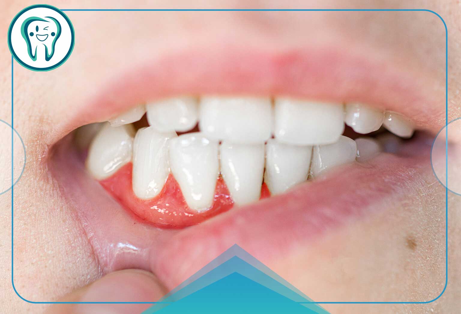 درمان خانگی درد لثه؛ دلایل، علائم و موثرترین روشهای تسکین سریع 1 نقش التهاب، عفونت و تحریک مکانیکی در بروز درد لثه