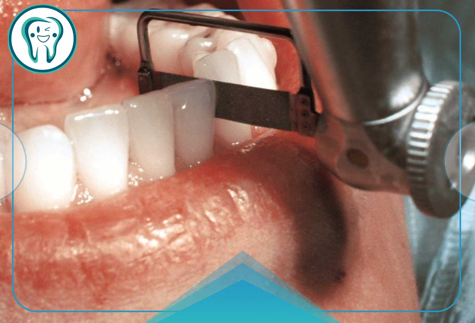 استریپ دندان؛ تجربهای سریع و بدون درد برای سفیدی دندان 6 استریپینگ دندان