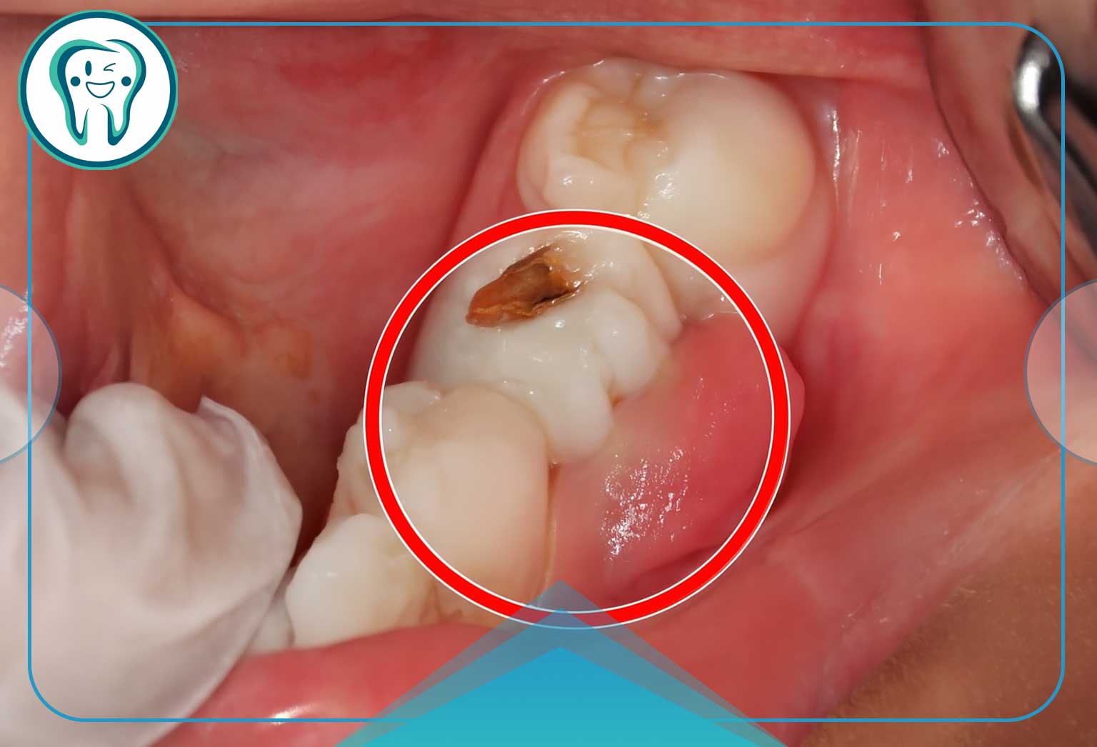 درمان خانگی درد لثه؛ دلایل، علائم و موثرترین روشهای تسکین سریع 4 انواع عفونت لثه