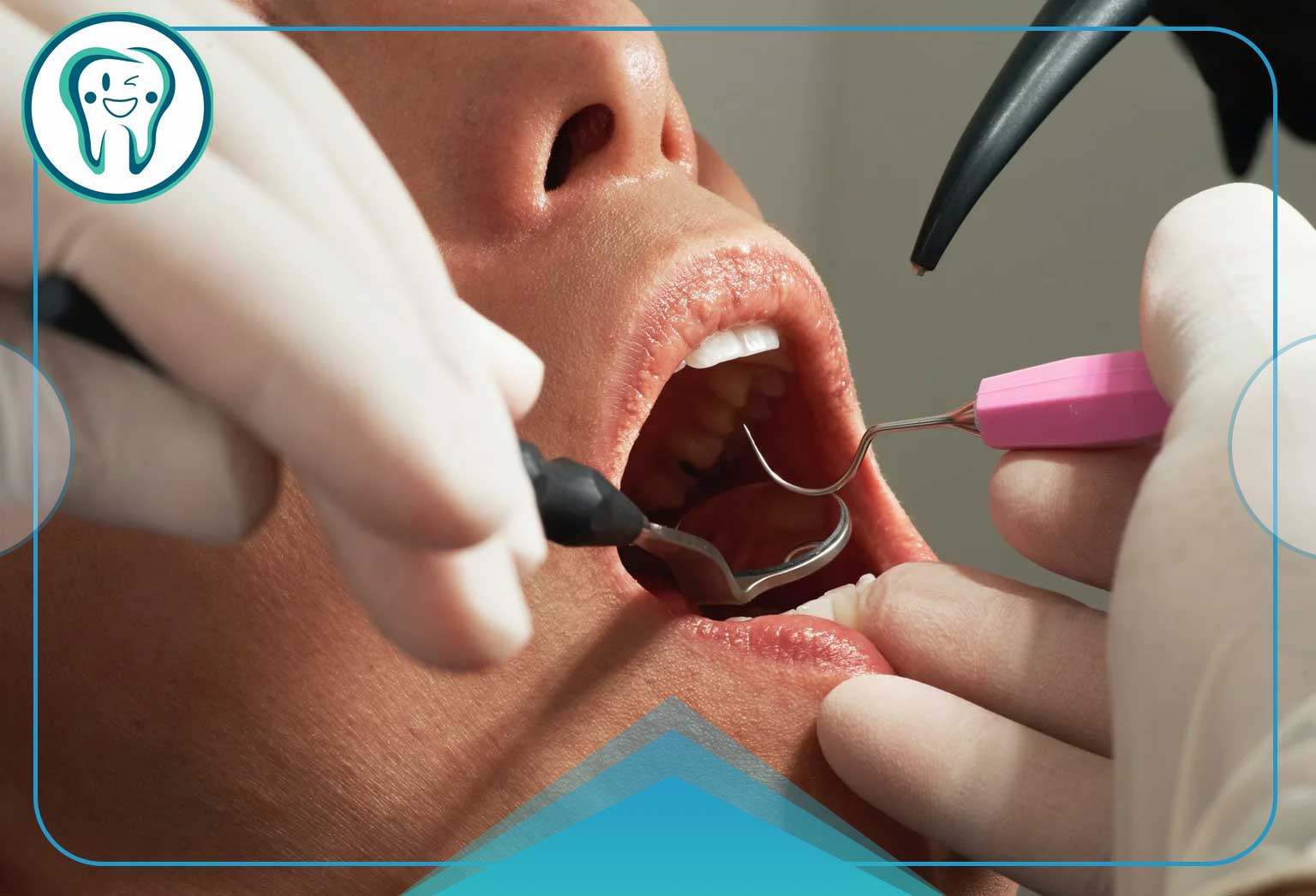 درمان ریشه دندان عقل