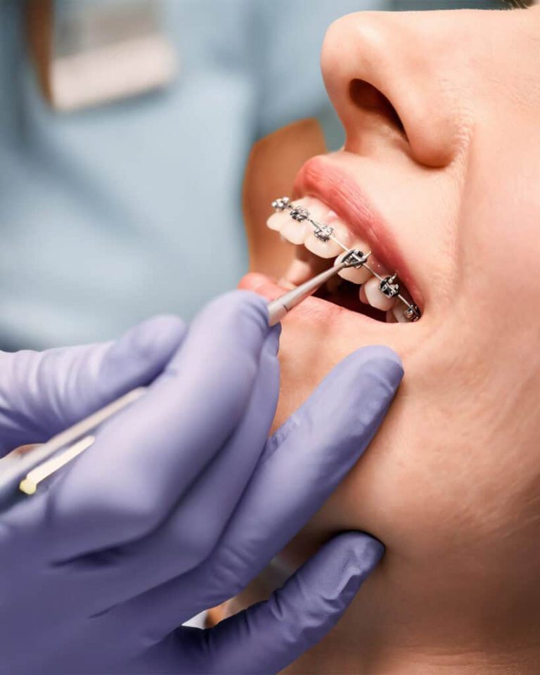 braces 819x1024 1
