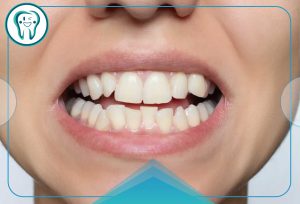 کج شدن دندان