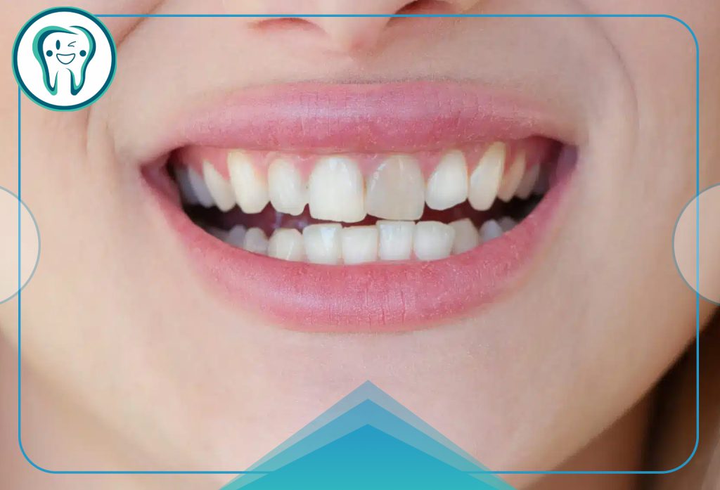 تغییر رنگ دندان پس از عصب کشی؛ دلایل، درمانها و بهترین روشهای سفید کردن 16 تغییر رنگ دندان پس از عصب کشی