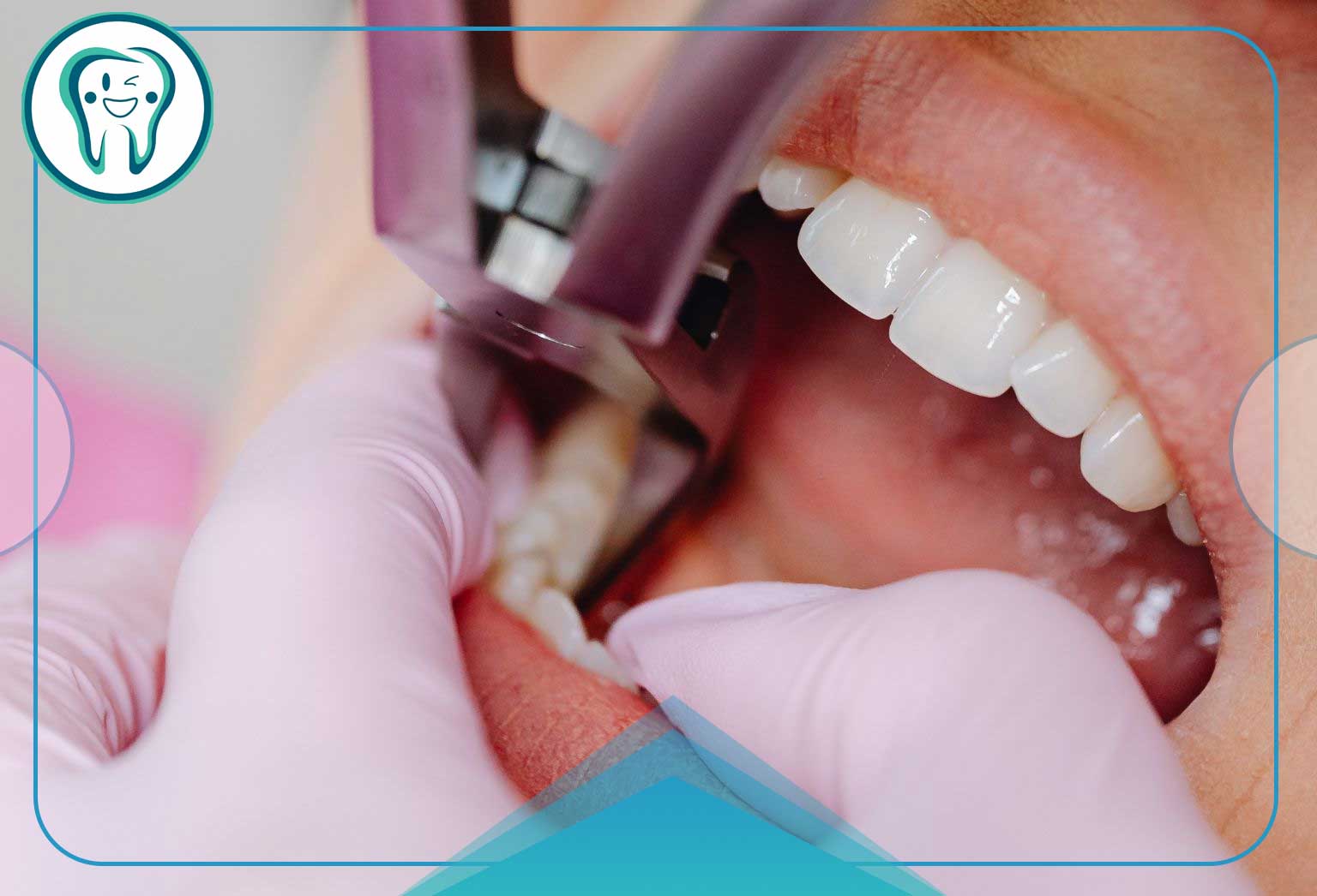 عوارض نکشیدن دندان عقل و هرآنچه باید درباره پیامدهای آن بدانید 5 کشیدن دندان عقل