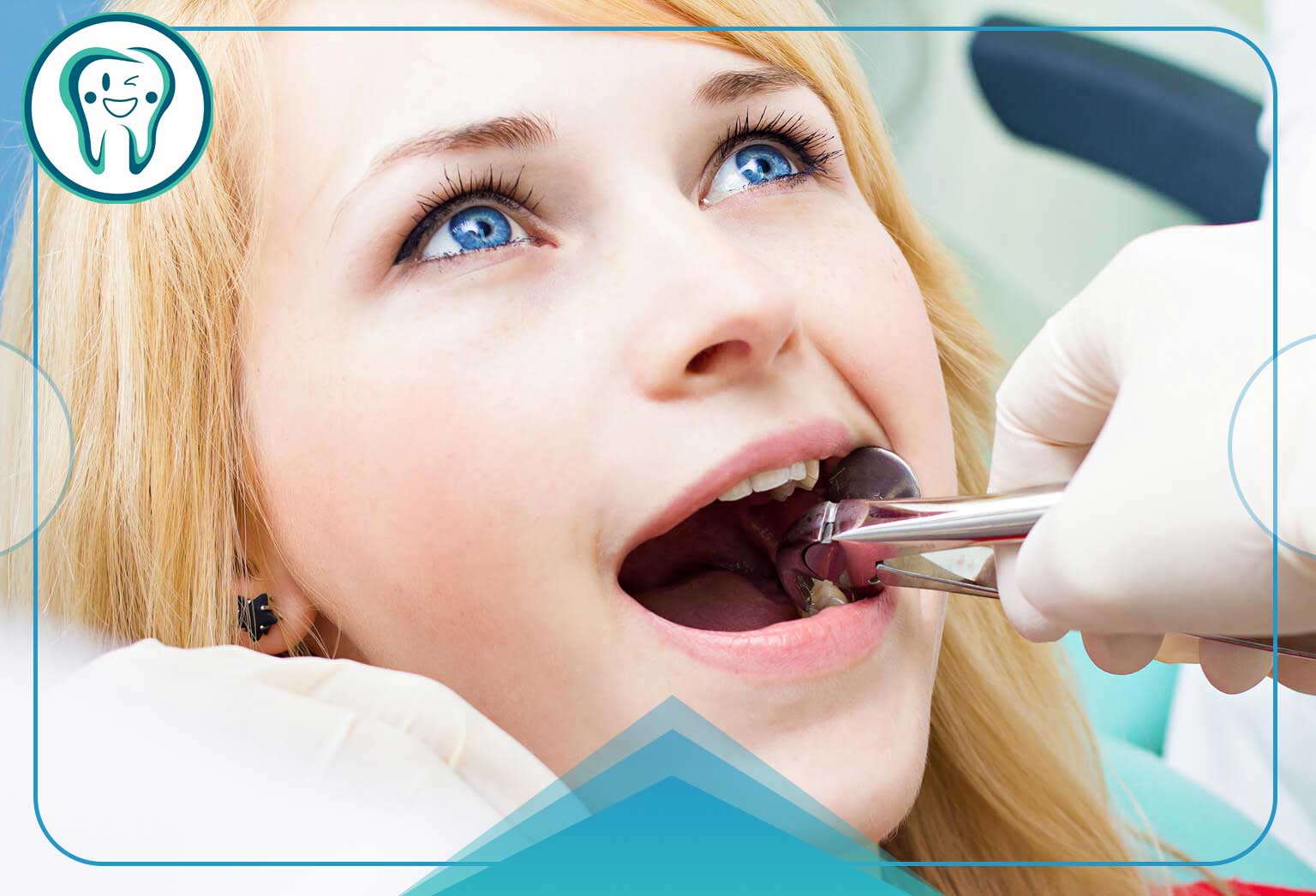 عوارض نکشیدن دندان عقل و هرآنچه باید درباره پیامدهای آن بدانید 1 کشیدن دندان عقل