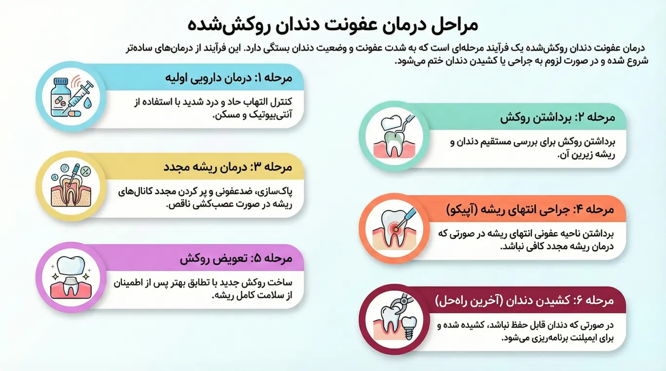 روش‌های درمانی عفونت دندان روکش‌شده