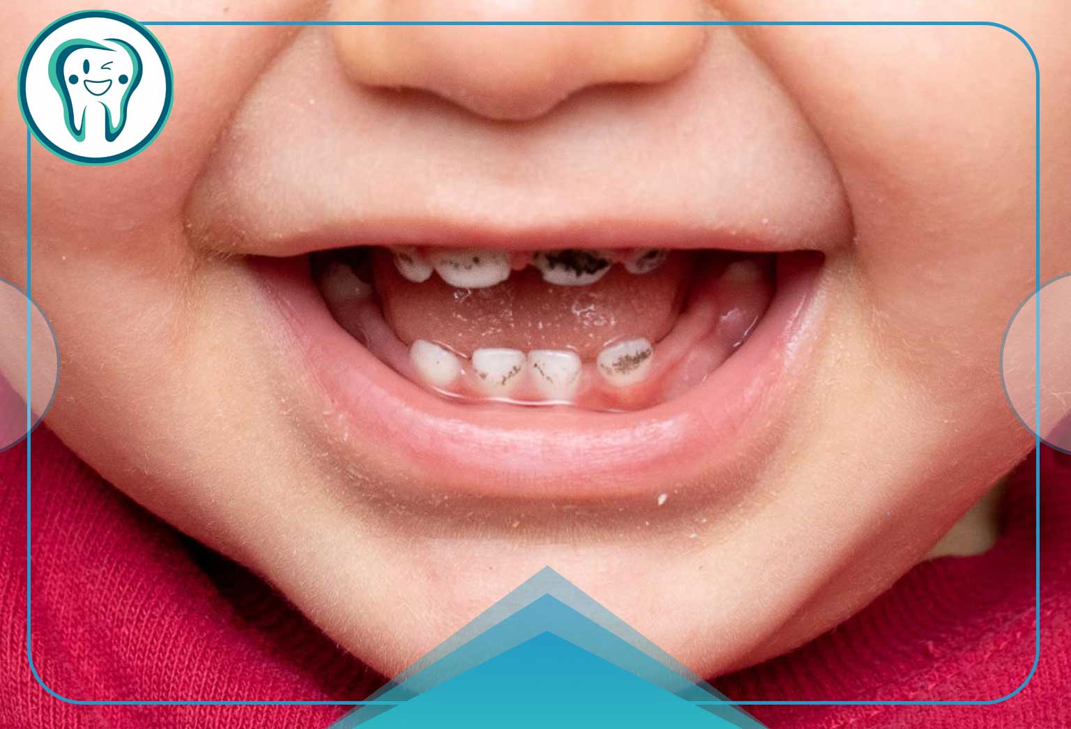 تأثیر قطره آهن برای کودکان : راهنمایی جامع و کامل برای والدین نگران 3 لکههای سیاه روی دندان کودکان