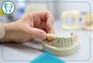 پل دندانپزشکی