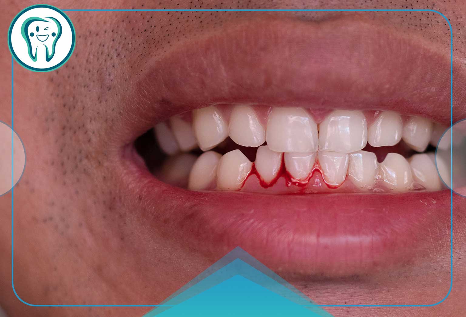 دلیل خونریزی لثه هنگام نخ دندان؛ حقیقتی که بسیاری نادیده میگیرند! 2 دلایل خونریزی لثه