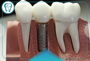 کلینیک دندانپزشکی قدس 26 عفونت ایمپلنت دندان