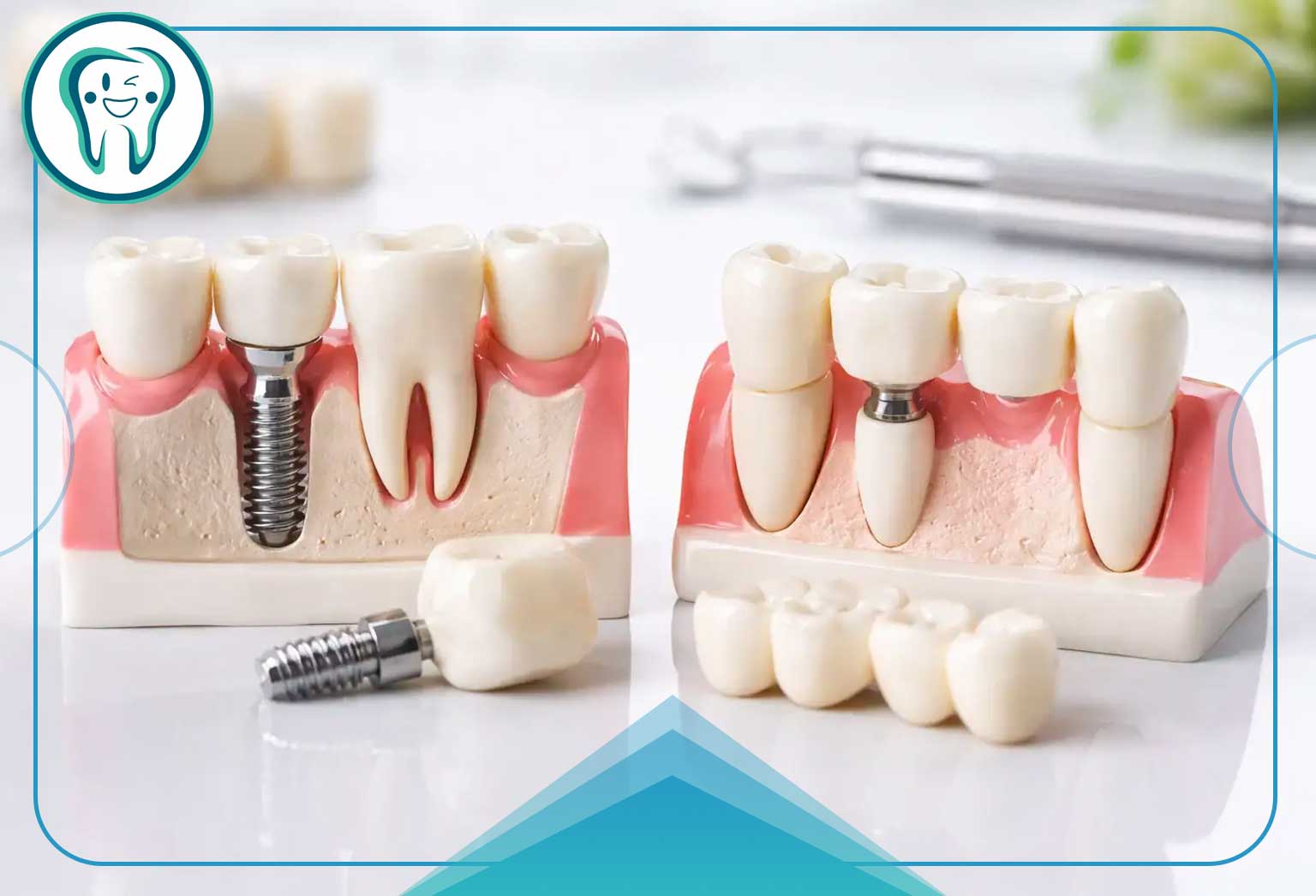 انواع پل دندانپزشکی و کاربرد هرکدام در درمان بیدندانی 5 تفاوت پل دندان با سایر روشهای جایگزینی