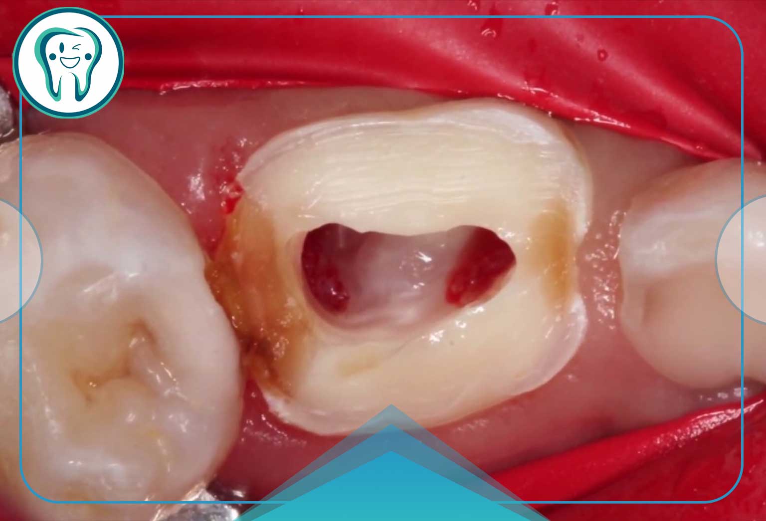 عصب کشی دندان شیری: آیا دندان شیری عصب کشی میشود؟ 2 پالپکتومی